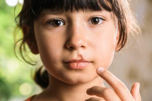  Girl with brown eyes and dark hair with cold sores on her lip. 