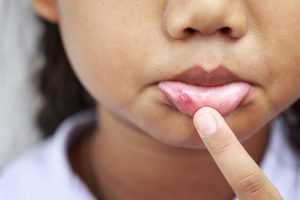 Girl with brown skin shows a canker sore inside her lip