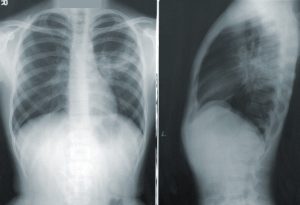 Front and side xray image of lungs